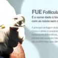 Transplante capilar técnica FUE em Curitiba