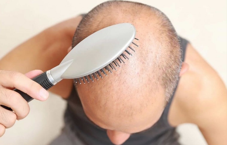 Como evitar a queda de cabelos